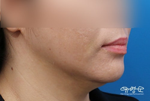 การยกกระชับแบบไฮบริด + ดูดไขมัน 사진 8