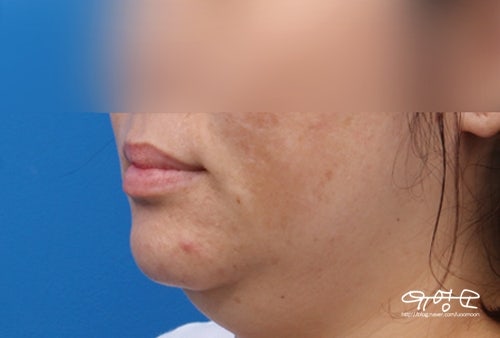 การยกกระชับแบบไฮบริด + ดูดไขมัน 사진 5