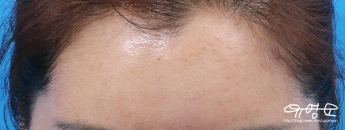 การปลูกถ่ายไขมันหน้าผาก 사진 14