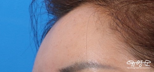 การปลูกถ่ายไขมันหน้าผาก 사진 6