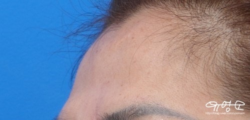 การปลูกถ่ายไขมันหน้าผาก 사진 5