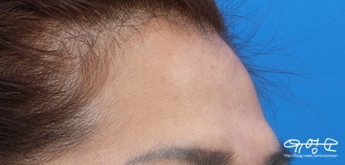 การปลูกถ่ายไขมันหน้าผาก 사진 7