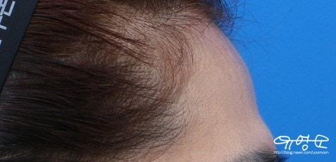 การปลูกถ่ายไขมันหน้าผาก 사진 9