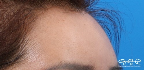 การปลูกถ่ายไขมันหน้าผาก 사진 8