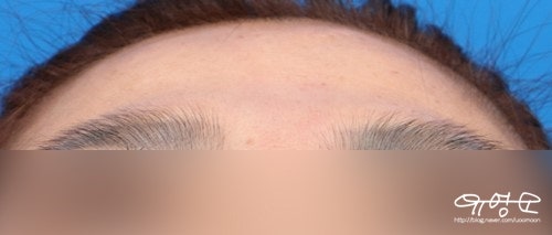 การปลูกถ่ายไขมันหน้าผาก 사진 11
