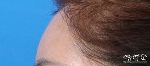 การปลูกถ่ายไขมันหน้าผาก 사진 4