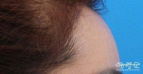 Cấy mỡ trán
