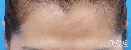 การปลูกถ่ายไขมันหน้าผาก 사진 13