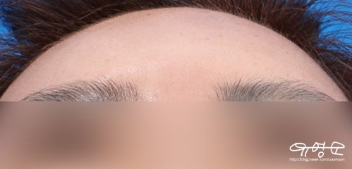 การปลูกถ่ายไขมันหน้าผาก 사진 12