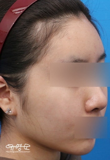 풀페이스 지방이식 사진 8