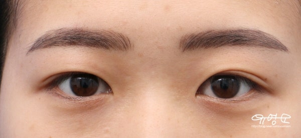 Penjahitan Alami + Epikantoplasti