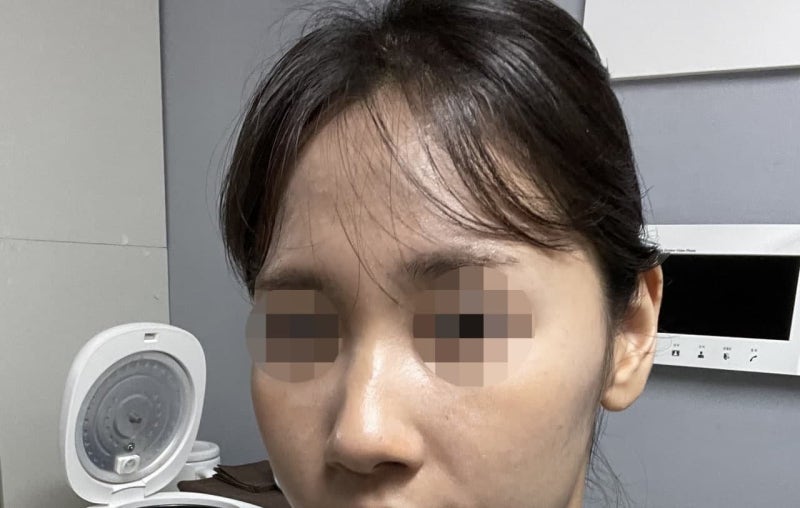 무보형물 코성형 (매부리 코, 복코) 사진 7