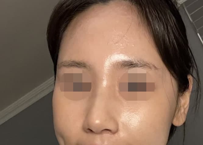 무보형물 코성형 (매부리 코, 복코) 사진 8