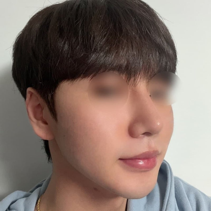 매부리, 휜코, 긴코 성형 사진 7