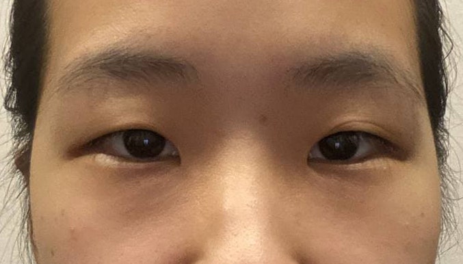 비절개 눈매교정, 앞트임