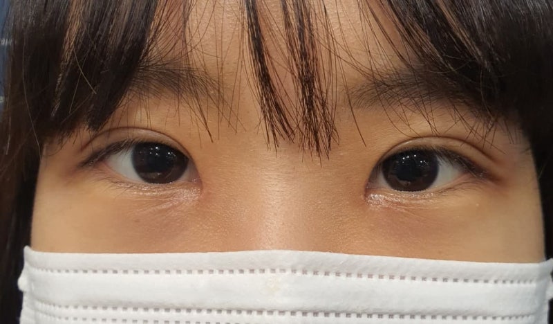 비절개 눈매교정, 앞트임 사진 4