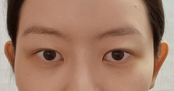 Koreksi Mata Tanpa Sayatan (Operasi Revisi), Epikantoplasti 사진 2