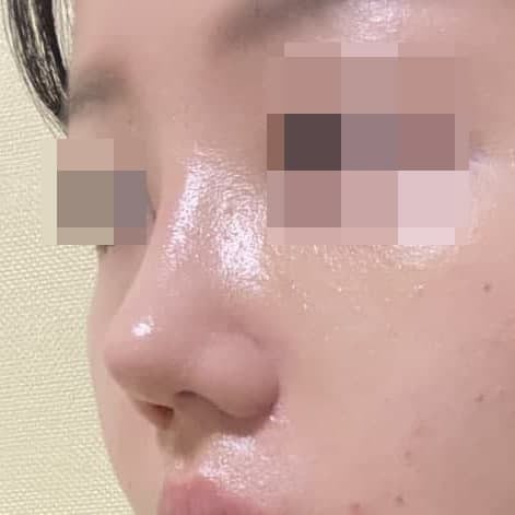 낮은 & 복코 교정, 콧볼 축소 사진 11