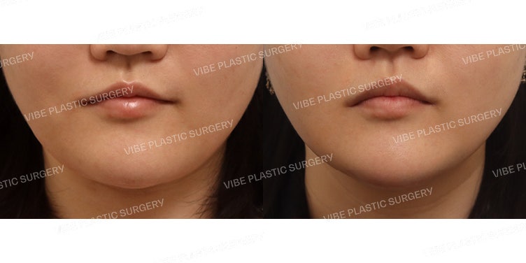 Ultrasonic Liposuction (Jawline & Double Chin)