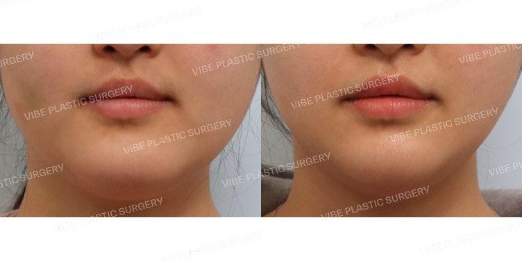 Ultrasound Liposuction (Jawline & Double Chin)