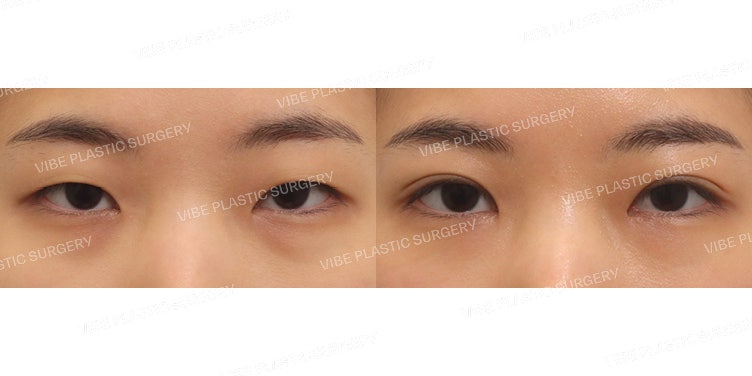 Koreksi Kelopak Mata Non-Insisi (Ptosis Correction)