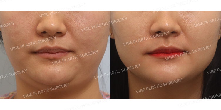 Ultrasound Liposuction (Jawline & Double Chin)