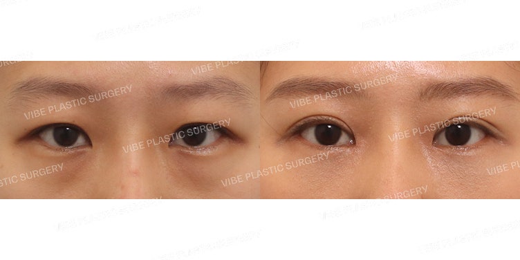 Incisional Ptosis Correction, Epicanthoplasty + Under-Eye Fat Repositioning