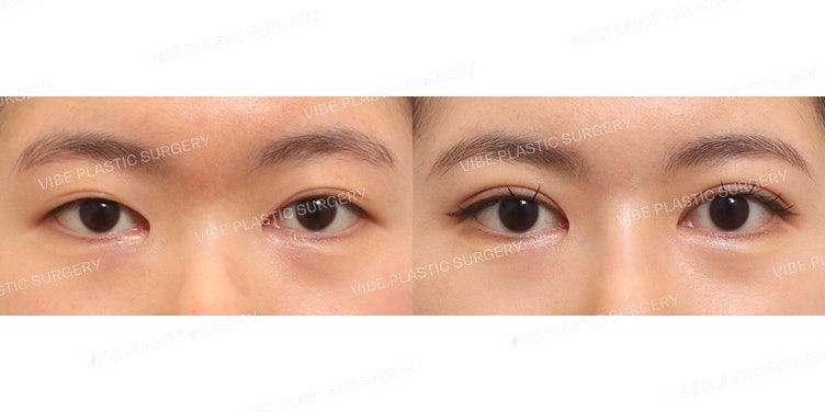 Phẫu thuật cắt mí (Tái phẫu thuật)