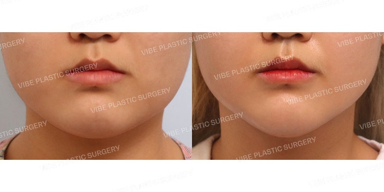 Ultrasound Liposuction (Jawline & Double Chin)