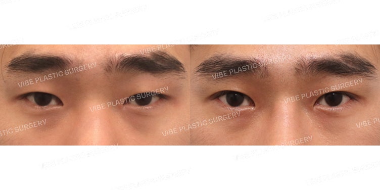 Male Eyelid Surgery (Natural Adhesion)