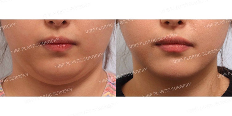 Sedot Lemak Ultrasonik (Garis Rahang & Double Chin)