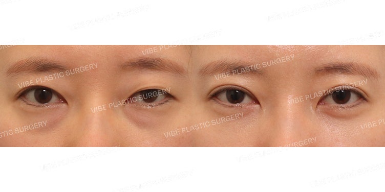 عملية تجميل الجفن المزدوج بالشق الجراحي (إعادة) وإعادة توزيع دهون أسفل العين