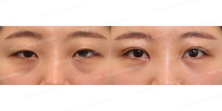 Chỉnh sửa sụp mí bán phần, mở rộng góc mắt trong, tái định vị mỡ dưới mắt