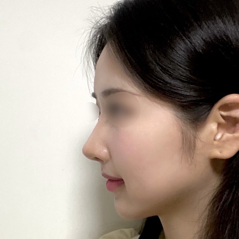 무보형물 코끝 성형 사진 6