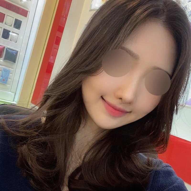 무보형물 코끝 성형 사진 7