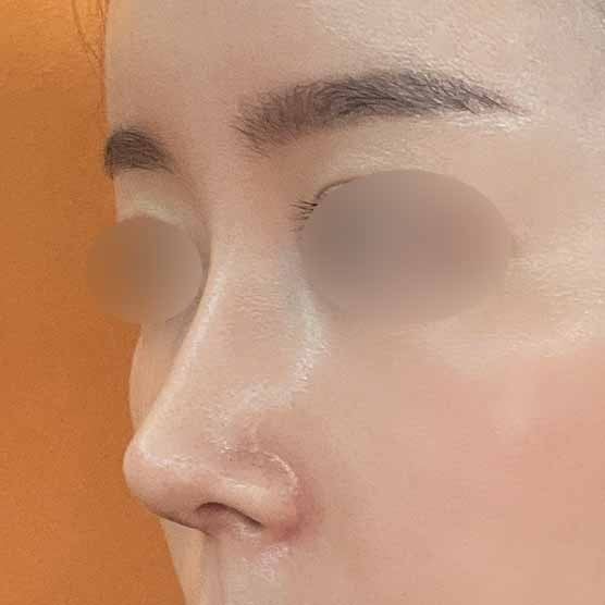 무보형물 코끝 성형 사진 8