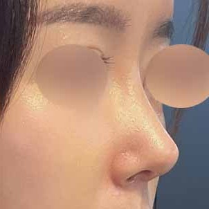 무보형물 코끝 성형 사진 7
