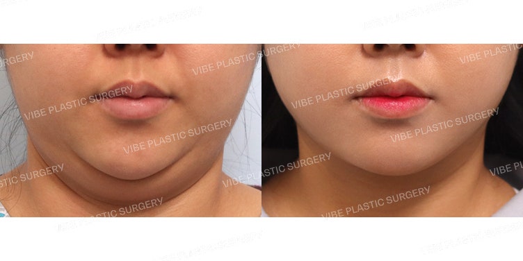 Ultrasound Liposuction (Jawline, Double Chin)