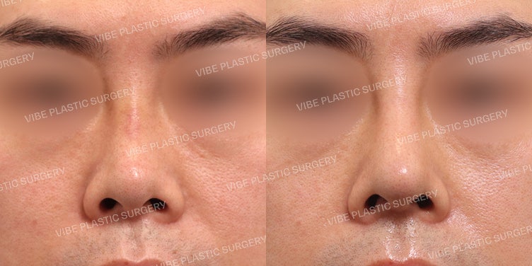 Men’s Short Nose Rhinoplasty, No-Scar Alar Reduction (+Functional Correction)