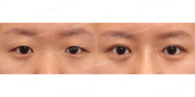 ศัลยกรรมปรับกล้ามเนื้อตาแบบกรีด & เปิดหัวตา