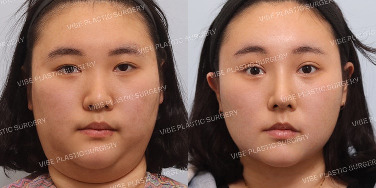 Fix-up Ptosis Correction, Rhinoplasty, Liposound, and Buccal Fat Removal