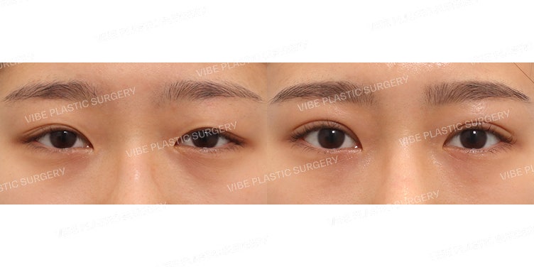 การแก้ไขกล้ามเนื้อตาอ่อนแรงด้วยวิธีเย็บแบบแผลเล็ก (Partial Incision Ptosis Correction)