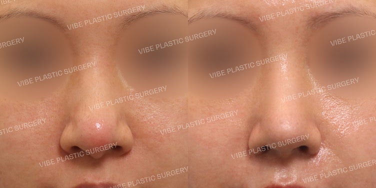 แก้จมูกชมพู่ แบบไม่ใช้ซิลิโคน (No-Implant)