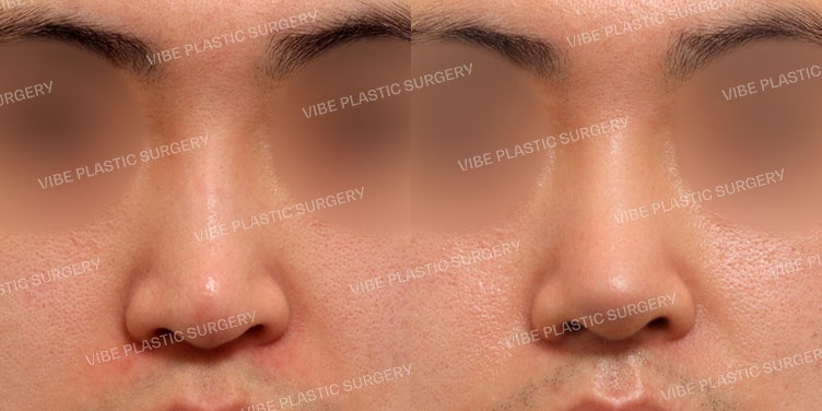تجميل الأنف بدون غرسات (تصحيح الأنف المعقوف والأنف الطويل) + تجميل الأنف الوظيفي