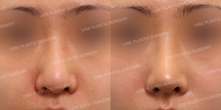 Operasi Hidung Bulat (Bulbous Nose) Tanpa Implan