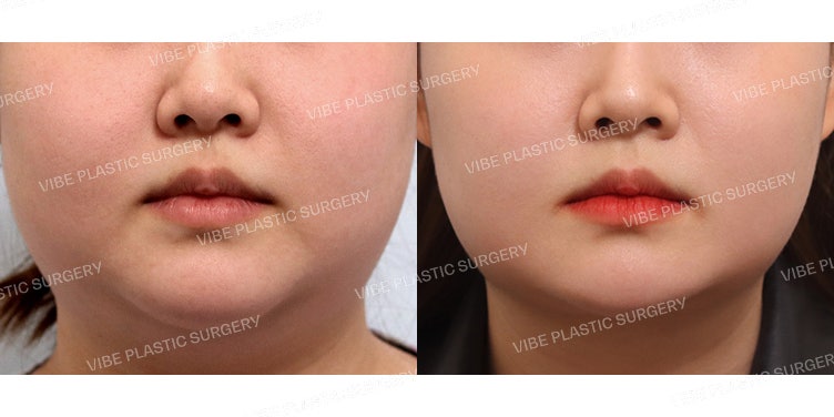 Loại bỏ mỡ má sâu & Hút mỡ bằng sóng siêu âm (Đường viền hàm, nọng cằm, má trước)