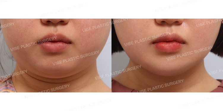 Hút mỡ LipoSound & Loại bỏ mỡ má trong (Buccal Fat)