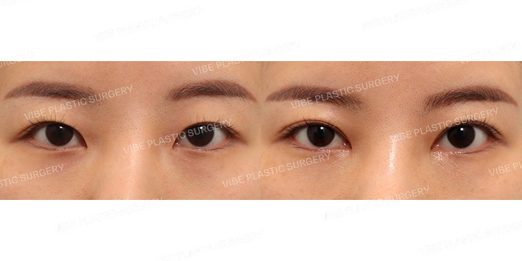 ทำตาสองชั้นแบบกรีด (แก้) และเปิดหัวตาบน