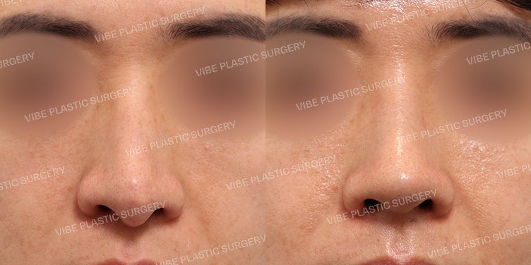 عملية إعادة تجميل الأنف للرجال (تصحيح الحاجز الأنفي والأنف المائل) وتجميل الأنف الوظيفي