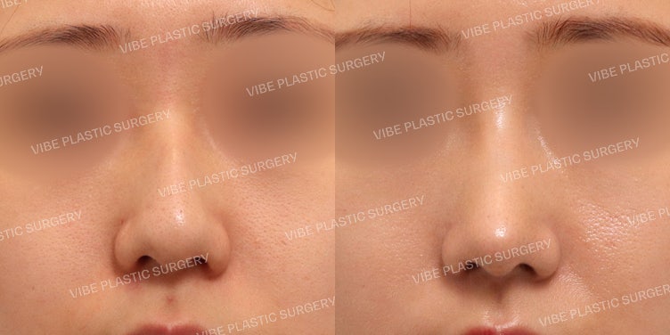 عملية تجميل الأنف بدون غرسات (الأنف المعقوف، الأنف الطويل)
